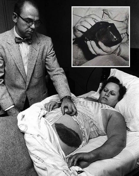 Um meteorito caiu na casa de Ann Hodges, no Alabama, em 1954. O ferimento que você vê foi o resultado do contato dele com a dona de casa, a primeira cidadã norte-americana a sofrer danos de um meteorito