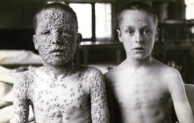 1) Esses dois meninos foram expostos à mesma fonte de varíola. Um foi vacinado e o outro não. A foto foi tirada pelo Dr. Allan Warner no início de 1900