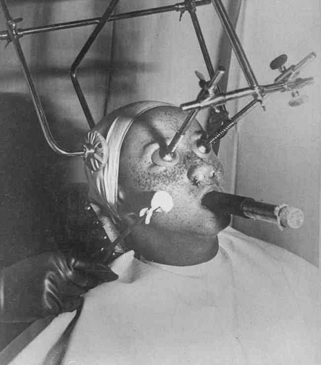 Paciente americano passando por tratamento bizarro anti-sardas, em 1933