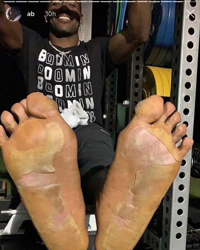 Pés do jogador de futebol americano Antonio Brow após sessão de crioterapia, procedimento no qual se aplica baixas temperaturas em regiões locais do corpo