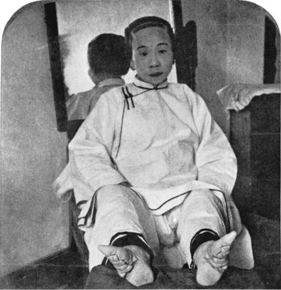 Senhora chinesa cujos pés estavam amarrados desde a infância. Esse procedimento tinha o objetivo de distinguir as meninas de classe alta das demais
