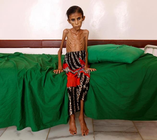 Fatima Ibrahim Hadi, de 12 anos, pesando apenas dez quilos. Ela sofria de desnutrição e foi internada numa clínica de Aslam, na província de Haijah, noroeste do Iêmen