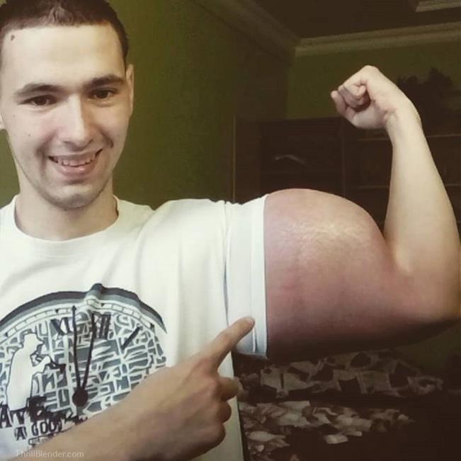 O russo que injetou óleo nos braços para ter bíceps maiores