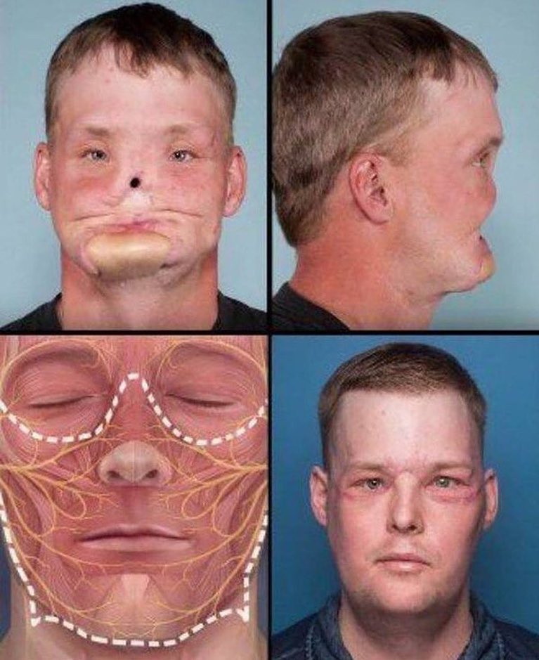 Transplante de rosto bem realizado