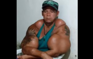 Aos 50 anos, Arlindo Anomalia pede ajuda para remover óleo dos braços