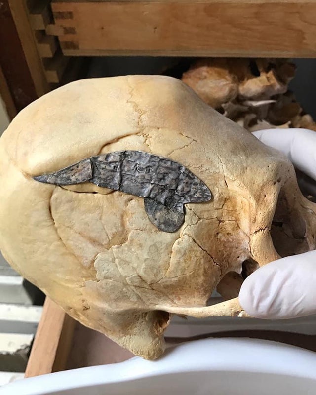 Crânio peruano alongado com metal implantado cirurgicamente. O osso quebrado ao redor do reparo está firmemente fundido, indicando que a cirurgia foi bem sucedida