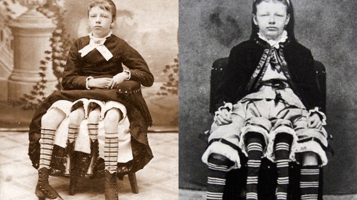 Josephine Myrtle Corbin nasceu em Lincoln County, Tennessee, em 1868. Ela nasceu com duas pernas ao lado da cintura. As pernas extras faziam parte de um gêmeo que não se dividiu corretamente, como no caso de Frank Lentini com sua terceira perna. Josephine disse que podia mover suas pernas adicionais, mas elas eram demasiadamente fracas para caminhar. Ela teve quatro filhas e um filho.