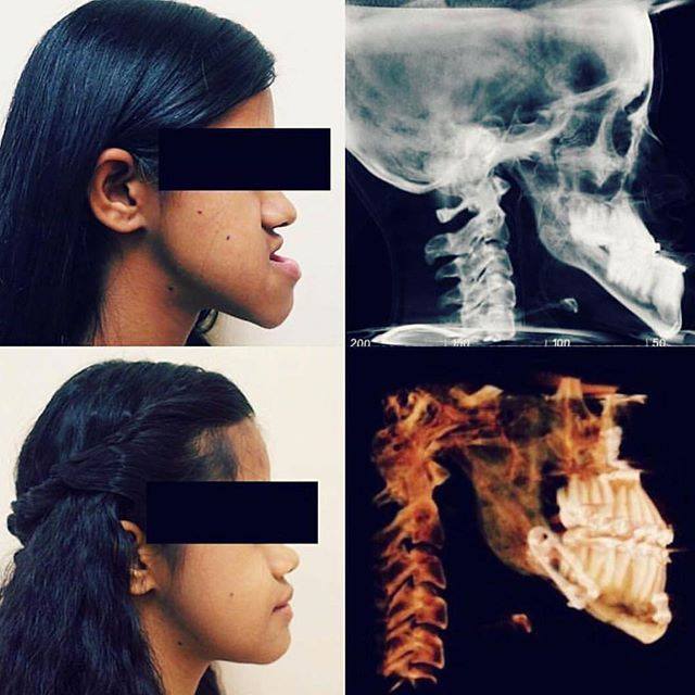 Resultado surpreendente de uma cirurgia corretiva que foi feita no maxilar inferior.