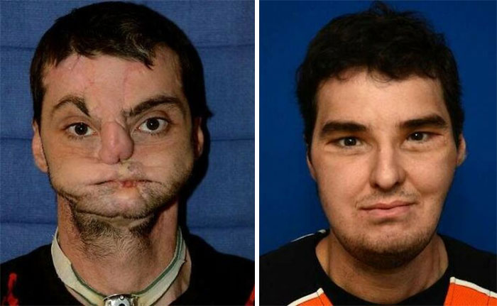 Antes e depois de transplante facial.