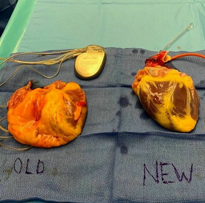 Transplante de coração - lado a lado, em comparação: coração antigo e coração novo.