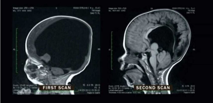 Imagem de Mri, um menino que nasceu com apenas 2% do cérebro. A segunda imagem, dois anos depois, mostra que ele cresceu 80% e atualmente ele só sofre de déficits cognitivos comparadamente pequenos.