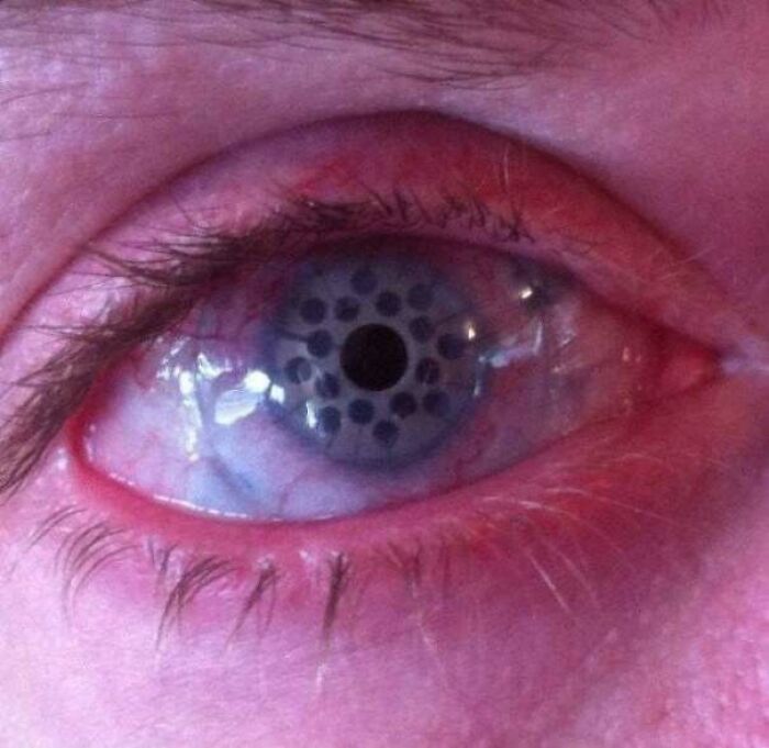 Esta é a aparência de um olho após ceratoprótese: um procedimento cirúrgico em que a córnea doente é substituída por uma córnea artificial.