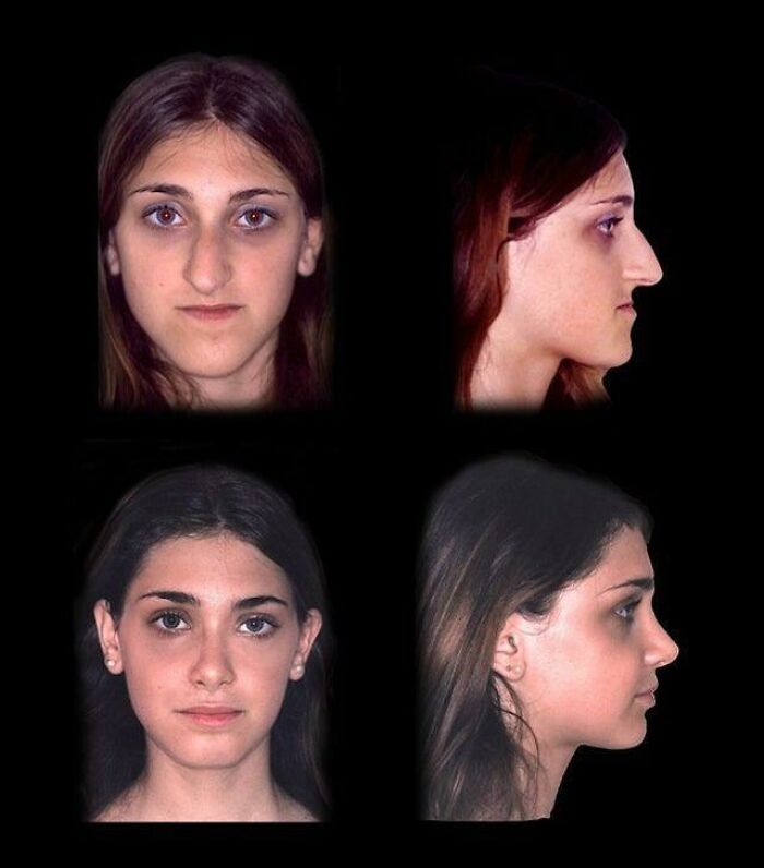 Antes e depois de cirurgia de mandíbula e rinoplastia numa mulher.