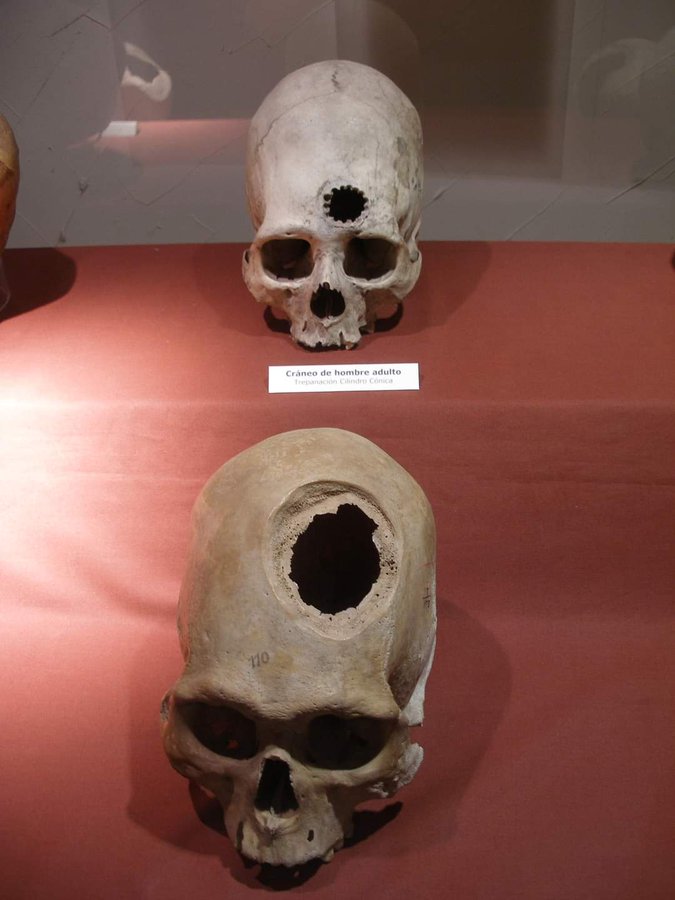 Os incas praticavam cirurgia cerebral, na qual um pedaço do crânio era arrancado e parte do cérebro era removida e o buraco coberto por metal batido e achatado. Essa foto mostra vestígios arqueológicos de um desses procedimentos feito pelos Incas, no século 15