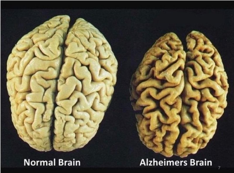 Cérebro normal versus cérebro com Alzheimer.