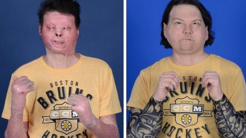 Joe DiMeo, um jovem de 22 anos, que foi submetido a um transplante de rosto e mãos que durou 23 horas. Um acidente em 2018 o deixou com queimaduras de terceiro grau em 80% do corpo. As pontas dos dedos foram amputadas e ele perdeu lábios e pálpebras