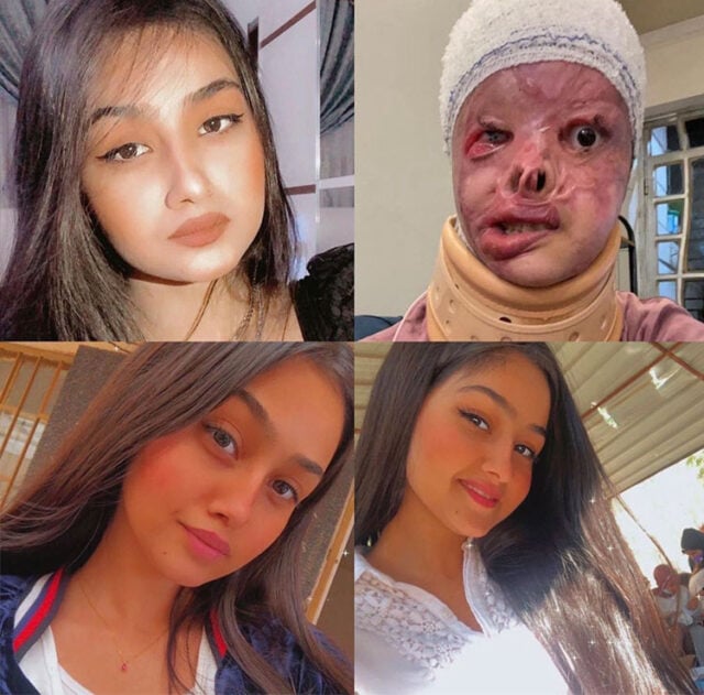 Esta é Maryam antes e depois do ataque. Ela tinha 16 anos e o agressor 19. Cerca de 80% do seu rosto foi queimado e ela ficou hospitalizada por meses lutando pela vida.