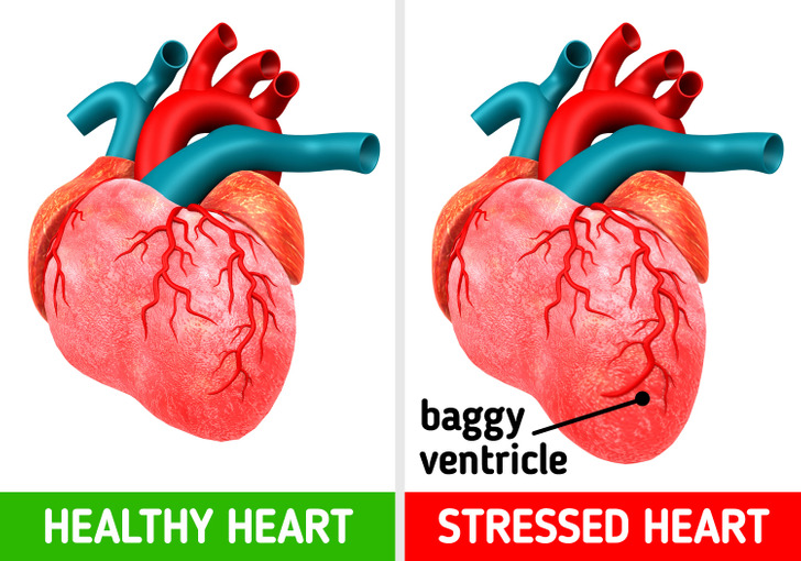 Isso pode soar como clichê, mas o estresse pode literalmente mudar a forma do seu coração. A síndrome de Takotsubo é uma condição que faz com que o ventrículo esquerdo mude de forma e não consiga bombear sangue adequadamente. Durante o estresse de curto prazo, 2 moléculas conhecidas por serem liberadas durante o estresse a depressão podem afetar a atividade das células do músculo cardíaco, levando a uma falha temporária. Felizmente, gerenciar o estresse e praticar técnicas de respiração e meditação curam essa condição sem a necessidade de medicação.