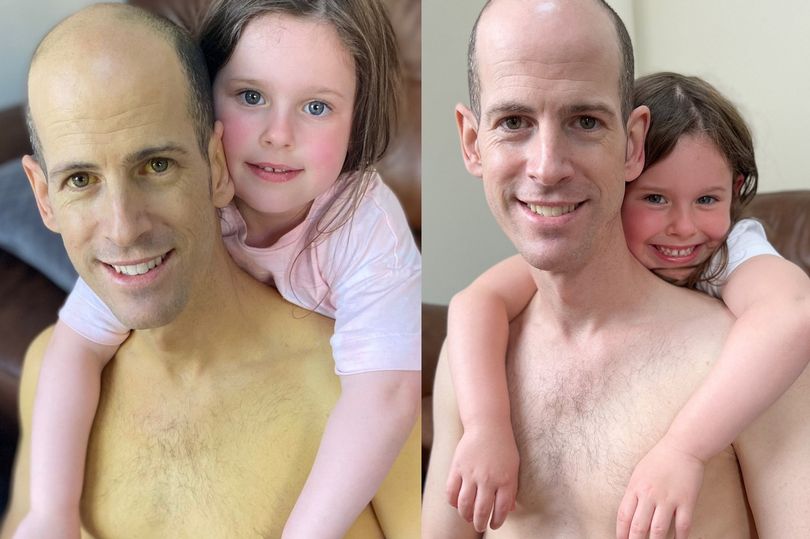 Homem compartilha foto antes e depois de um transplante de fígado. A foto da esquerda o ajudou a identificar que havia algum problema de saúde com ele.