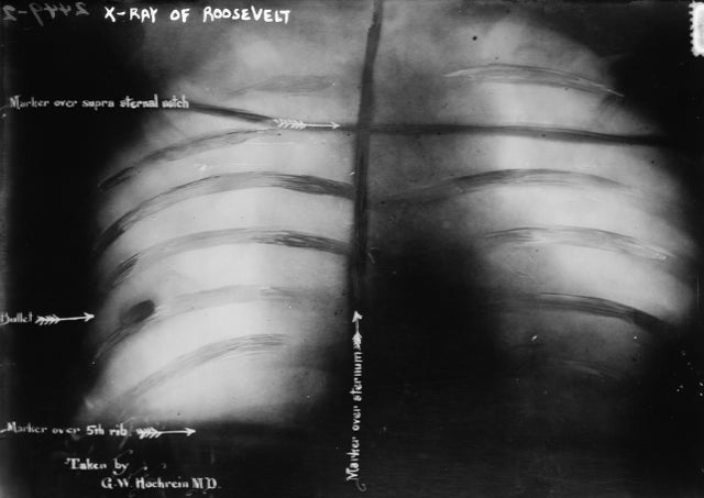 Radiografia de tórax de Theodore Roosevelt tirada em 14 de outubro de 1912 depois que ele foi baleado durante uma tentativa de assassinato. Os médicos consideraram a bala muito perigosa para remover e Roosevelt a carregou pelo resto da vida.